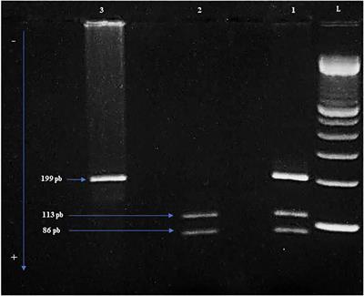 TP53 Gene 72 Arg/Pro (rs1042522) single nucleotide polymorphism increases the risk and the severity of chronic lymphocytic leukemia